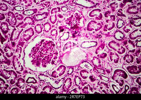 Glomerulonephritis. Lichtmikrographisches Nierengewebe bei diffuser sklerosierender Glomerulonephritis. Stockfoto