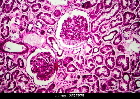 Glomerulonephritis. Lichtmikrographisches Nierengewebe bei diffuser sklerosierender Glomerulonephritis. Stockfoto