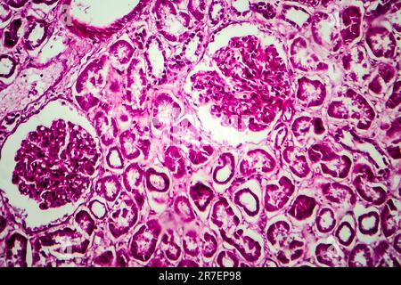 Glomerulonephritis. Lichtmikrographisches Nierengewebe bei diffuser sklerosierender Glomerulonephritis. Stockfoto