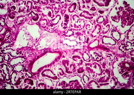 Glomerulonephritis. Lichtmikrographisches Nierengewebe bei diffuser sklerosierender Glomerulonephritis. Stockfoto