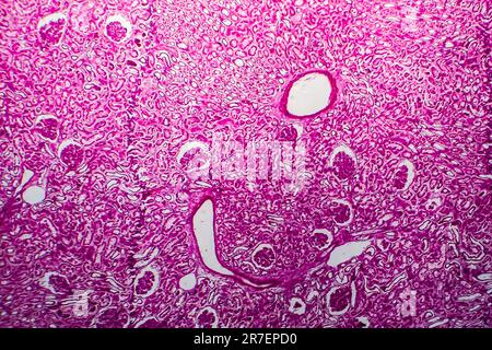 Glomerulonephritis. Lichtmikrographisches Nierengewebe bei diffuser sklerosierender Glomerulonephritis. Stockfoto