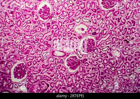 Glomerulonephritis. Lichtmikrographisches Nierengewebe bei diffuser sklerosierender Glomerulonephritis. Stockfoto