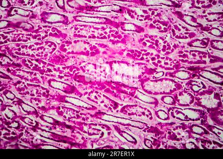 Glomerulonephritis. Lichtmikrographisches Nierengewebe bei diffuser sklerosierender Glomerulonephritis. Stockfoto