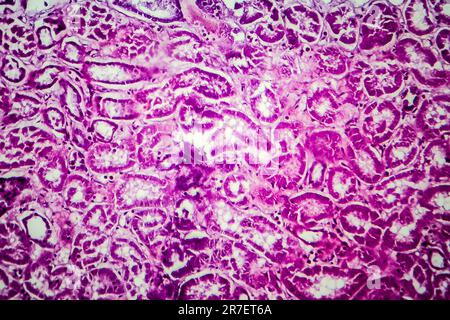 Glomerulonephritis. Lichtmikrographisches Nierengewebe bei diffuser sklerosierender Glomerulonephritis. Stockfoto