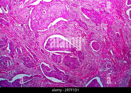 Gebärmutterhalskrebs. Licht Schliffbild (LM), einen Abschnitt über ein Plattenepithelkarzinom der Zervix. Gebärmutterhalskrebs ist eine Krebserkrankung des Gebärmutterhalses, wh Stockfoto