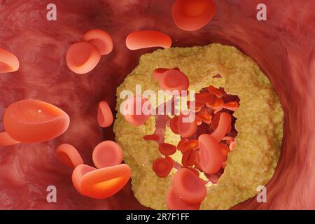 Blutgefässe durch Cholesterin verengt, durch die rote Blutkörperchen fließen. Illustration des Krankheitsbegriffs hoher Cholesterinspiegel Stockfoto