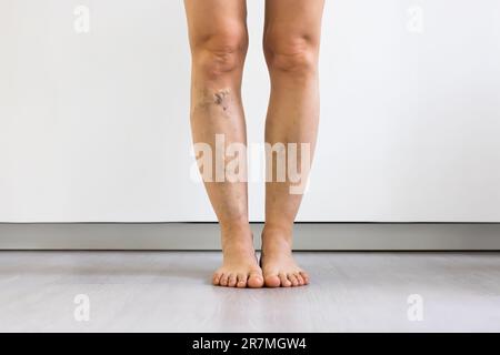 Vor Nach Cellulite Entzündung Beine Behandlung Closeup Stockfoto