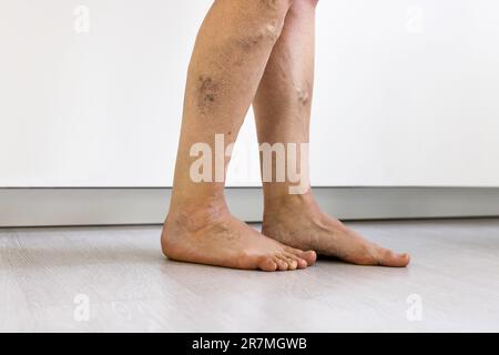 Vor Nach Cellulite Entzündung Beine Behandlung Closeup Stockfoto