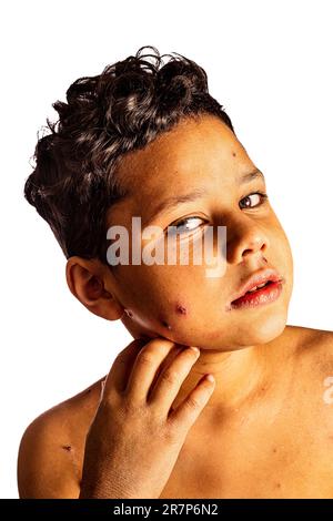 Ein siebenjähriger Junge mit Windpocken. Windpocken sind eine hoch ansteckende Virusinfektion. Sie breitet sich leicht von Mensch zu Mensch aus und tritt am häufigsten bei Kleinkindern auf. Das Hauptsymptom ist ein juckender, fleckiger Ausschlag mit kleinen Blasen, die sich über den ganzen Körper ausbreiten können. Für die meisten Menschen sind Windpocken nichts Ernstes und heilen von selbst innerhalb weniger Wochen. Die Symptome können mit Kühlcremes und Schmerzmitteln gelindert werden. Stockfoto