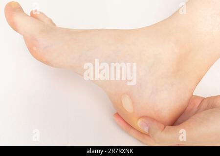 Die Person zeigt Fuß mit Schwielen, Hautkörnern an der Ferse und Zehenpfanne. Wasserblasenkrankheit Am Fuss. Schmerzhafte Verknöcherung Vor Der Behandlung. Nahaufnahme Stockfoto