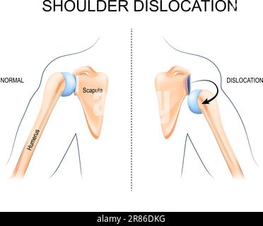 Schulterluxation. Oberarmknochentrauma, Sportverletzungen oder schwache Schultermuskulatur. Die Anatomie des menschlichen Arms. Knochen und Gelenk der Schulter und Hand. Stock Vektor