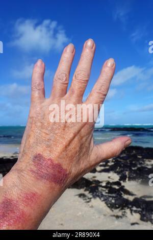 Purpura, senile Purpura Stockfoto