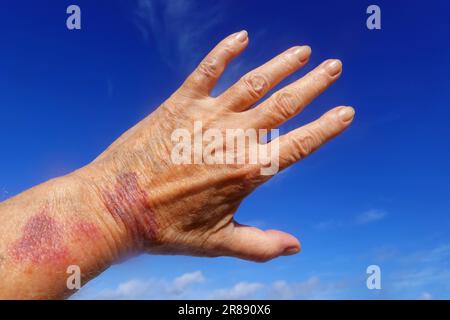 Purpura, senile Purpura Stockfoto