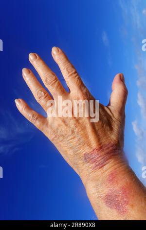 Purpura, senile Purpura Stockfoto