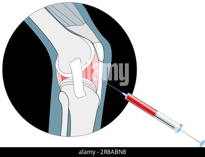 Nicht-chirurgische Arthrosebehandlungen. Injektionen in das schmerzhafte Gelenk. Wirksamkeit plättchenreicher Plasmainjektionen oder PRP-Therapie. Hyaluronsäure, Stock Vektor