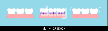 Weißzahn und mit gelber Tartar-Plaque vor Plaque-Test-Symbol gesetzt. Zähne in der Zahnfleischfärbung, -Entfernung und -Reinigung, Weißmacherkonzept. Den Stock Vektor