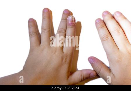 Finger geschwollen mit Entzündung durch Nagelriss-Infektion Stockfoto