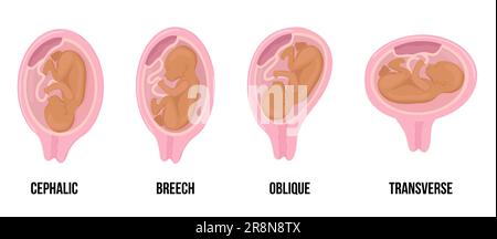 lateinarabisches braunes Hautbaby. Unterschiedliche Fehlstellungen im Uterus während der Schwangerschaft. Schädel-, Breech-, Quer-, schräge Lügen. Farbige Medizin Stock Vektor