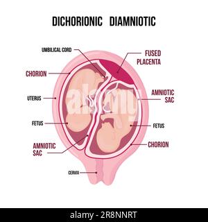 Zur Anatomie des Zwillingsabdomens. Schwangerschaftstyp-Infographieelemente im flachen Design. Dichorionische diamniotische Zwillinge mit verschmolzener Plazenta medizinisches Diagramm ist Stock Vektor