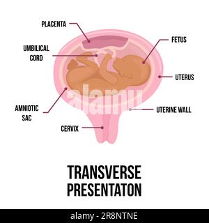 Transversale Babypräsentation. Falsche Babylagen im Uterus während der Schwangerschaft. Farbige medizinische Vektordarstellung. Fötus mit Nabelschnur, Zervix Stock Vektor