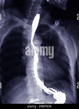 Barium Swallow study Test diagnostiziere Barrett's GI tract exam GERD ulcers series difficulty pharynx procedure UGI throat darm therapy by Fluoroscopy dev Stockfoto