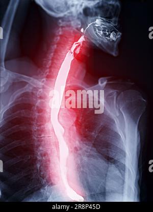 Barium Swallow study Test diagnostiziere Barrett's GI tract exam GERD ulcers series difficulty pharynx procedure UGI throat darm therapy by Fluoroscopy dev Stockfoto