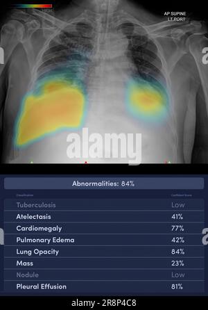 Thoraxröntgenbild mit (AI : Artificial Intelligence) Report. Stockfoto