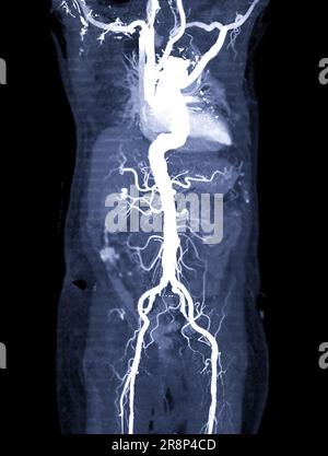 CTA-3D-Rendering der gesamten Aorta. Stockfoto