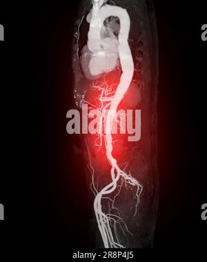 CTA-3D-Rendering der gesamten Aorta. Stockfoto