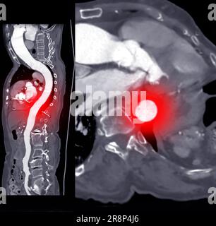 MPR-Kurve der gesamten Aorta der CTA. Stockfoto