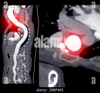 MPR-Kurve der gesamten Aorta der CTA. Stockfoto