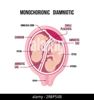 Zur Anatomie des Zwillingsabdomens. Schwangerschaftstyp-Infographieelemente im flachen Design. Monochorionische diamniotische Zwillinge, medizinisches Diagramm auf weißem Ba isoliert Stock Vektor