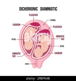 Zur Anatomie des Zwillingsabdomens. Schwangerschaftstyp-Infographieelemente im flachen Design. Dichorionische diamniale Zwillinge, medizinisches Diagramm auf weißem Rücken isoliert Stock Vektor