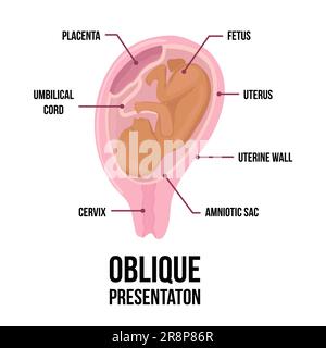 Die schräge Babylage im Uterus während der Schwangerschaft. Gefährliche Situationen. Farbiges medizinisches Vektordiagramm mit Begriffen. Fötus mit Nabelschnur und Ort Stock Vektor