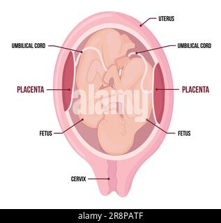 Zwillinge im Mutterleib. Monozygote Schwangerschaft mit zwei inneren Kindern. Medizinisches Vektordiagramm mit Begriffen Stock Vektor