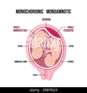 Zur Anatomie des Zwillingsabdomens. Schwangerschaftstyp-Infographieelemente im flachen Design. Monochorionische eineiige Zwillinge, medizinisches Diagramm auf weiß isoliert Stock Vektor