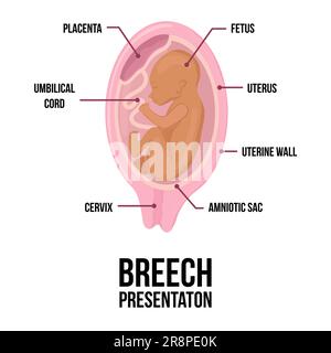 Beckenendlage im Uterus während der Schwangerschaft. Farbiges medizinisches Vektordiagramm mit Begriffen. Fetus mit Nabelschnur und Plazenta Stock Vektor