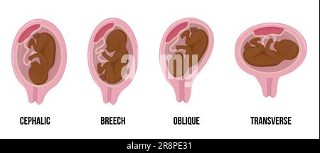 Afrikanisches schwarzes Hautbaby. Unterschiedliche Fehlstellungen im Uterus während der Schwangerschaft. Schädel-, Breech-, Quer-, schräge Lügen. Farbiger medizinischer Vektor Stock Vektor