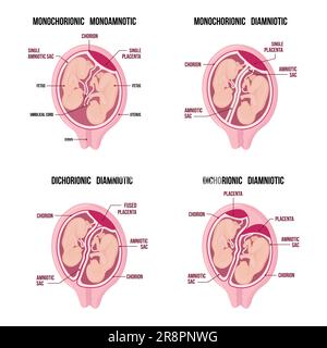 Zur Anatomie des Zwillingsabdomens. Schwangerschaftstypen-Infographieelemente im flachen Design. Monochorionische diamniotische Zwillinge, medizinisches Diagramm auf weißem b isoliert Stock Vektor