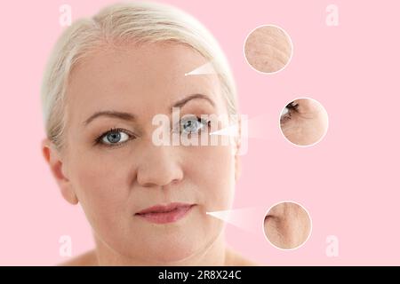 Schöne reife Frau mit pinkfarbenem Hintergrund. Vergrößerte Hautbereiche mit Falten vor Verjüngungseingriffen Stockfoto