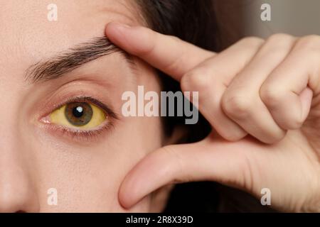 Frau mit gelben Augen auf verschwommenem Hintergrund, Nahaufnahme. Symptom der Hepatitis Stockfoto