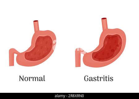 Anatomie des menschlichen gesunden und ungesunden Magens, medizinisches Poster mit einem detaillierten Diagramm der Struktur aus dem Inneren des Magens, Erkrankungen des Verdauungssystems - normal und Gastritis. Vektordarstellung Stock Vektor