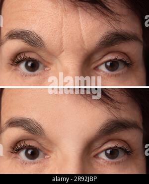 Reife Frau vor und nach Hautstraffungsbehandlungen. Collage mit Fotos, Nahaufnahme Stockfoto