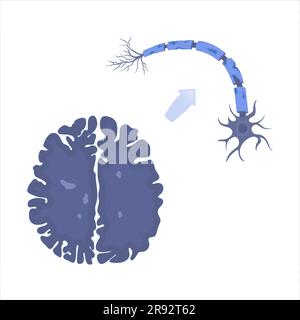 Multiple Sklerose, konzeptuelle Illustration Stockfoto