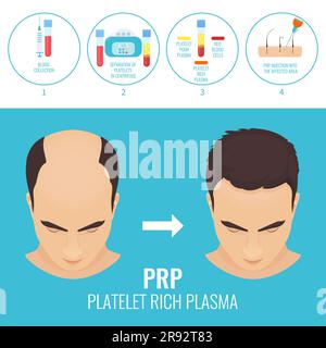 PRP Haarausfall Behandlung, Illustration Stockfoto