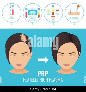 PRP Haarausfall Behandlung, Illustration Stockfoto