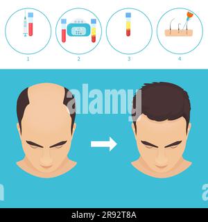 PRP Haarausfall Behandlung, Illustration Stockfoto