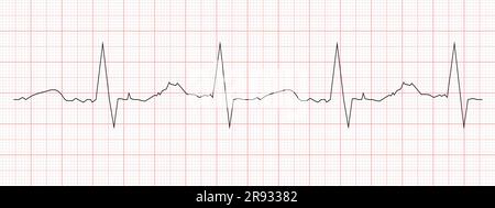 Schwarzes Herzschlagdiagramm auf rotem Papier gedruckt. EKG-Akte. Herzrhythmuslinie. Cardio-Test-Zeichen. Symbol für Kardiologie-Klinik Stock Vektor