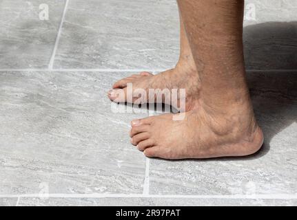 Die Füße älterer Frauen haben Krampfadern Stockfoto