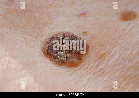 Gefährlicher Maulwurf Stockfoto